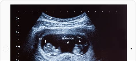 what is a dating and viability ultrasound
